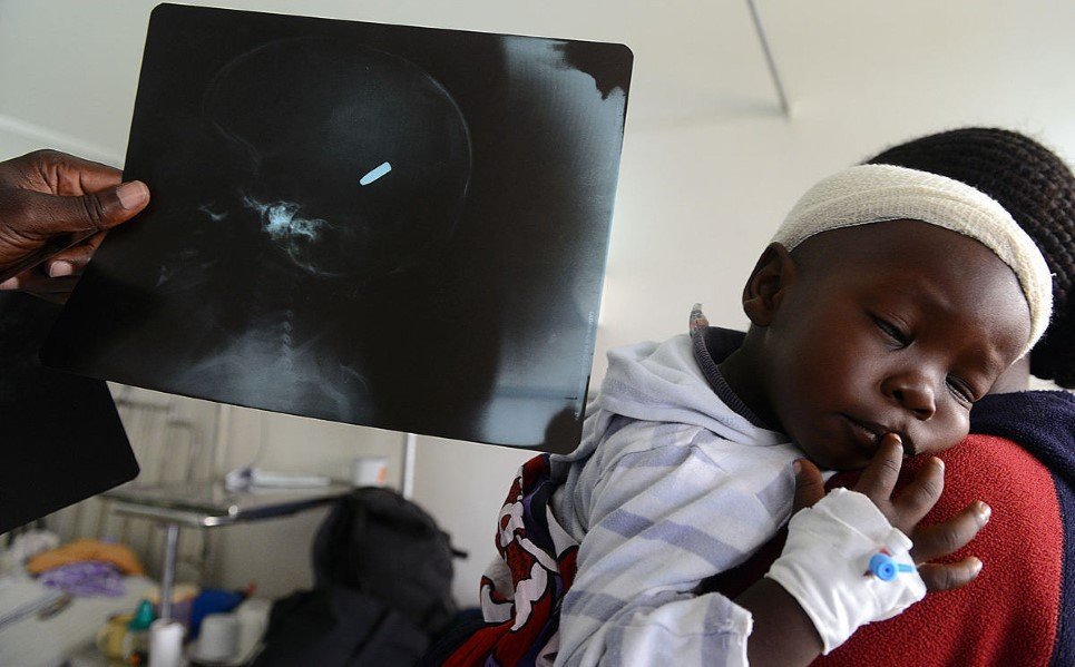 5. An X-ray film shows a bullet lying inside the skull of an 18 month old boy Satrin Osinya, being treated at the Kenyatta National hospital Nairobi - March 26, 2014.