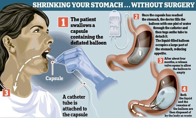 Elipse Gastric Balloon 2